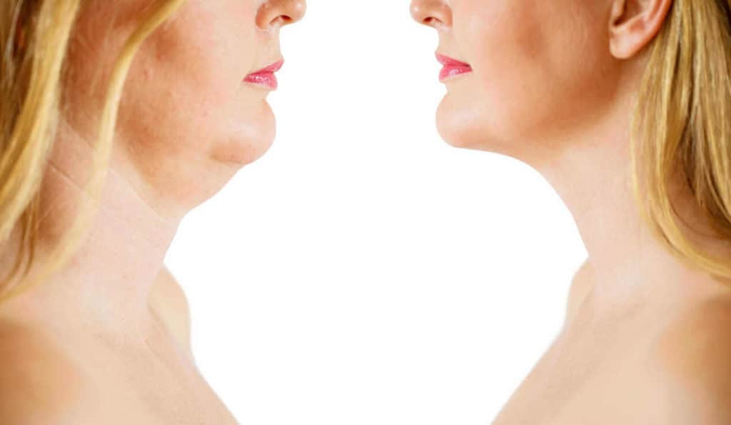 Double Chin treatment Merton Park before and after results