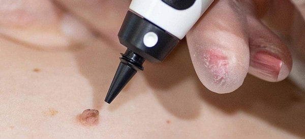 After Skin Tag Removal Merton Park
