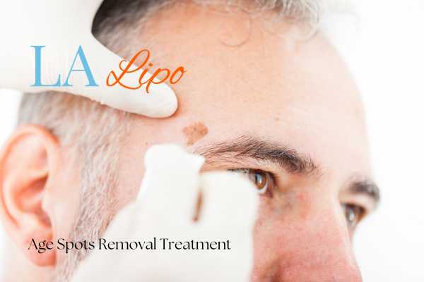 What Are the Most Effective Treatments for Age Spots Merton Park?