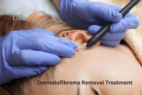 Dermatofibroma Removal Treatment Merton Park