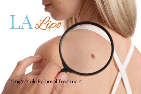 Why getting moles removed Merton Park can boost your confidence!