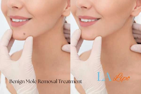 woman's before and after mole removal Merton Park results