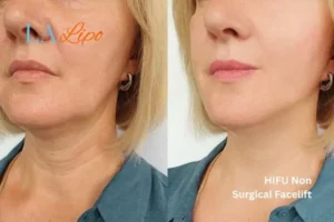 hi-fu for wrinkles Merton Park before and after results