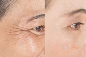 Before and after results of woman - HI-fu wrinkles reduction treatment Merton Park