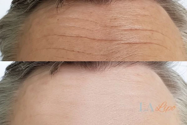 results of HIFU Merton Park on mans forehead to help reduce lines and wrinkles