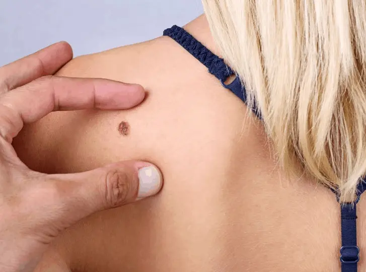 woman having mole removal Merton Park consultation before treatment.