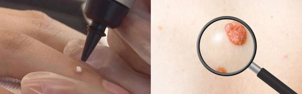Person getting moles removed with cryopen Merton Park