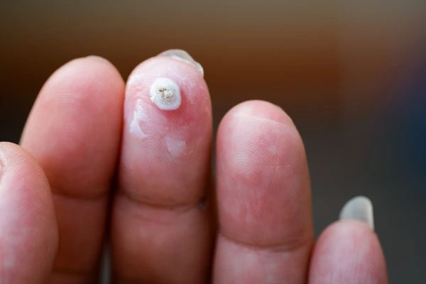 wart on person finger - cryotherapy to treat from LA LIPO Merton Park