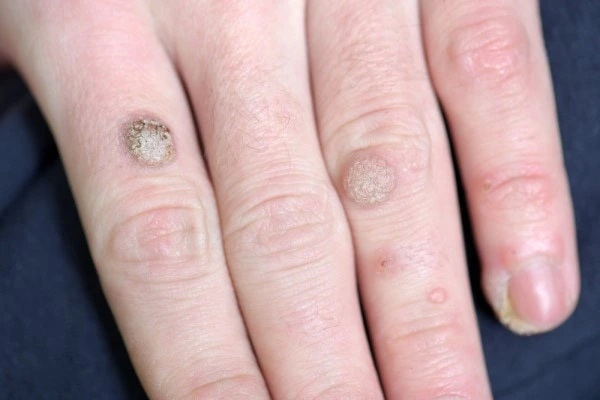 photo of warts on person hand - see wart removal Merton Park from LA LIPO