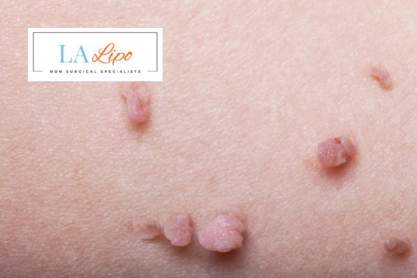 Does cryopen skin tag removal Merton Park hurt? Find out now call our team today!