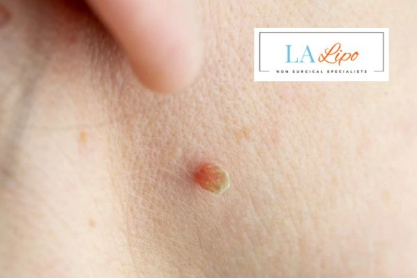 Book skin tag removal Merton Park today speak to our team now!