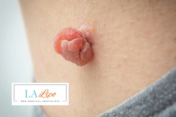 Interested in skin tag removal Merton Park? Concerned about the pain? Find out more today!