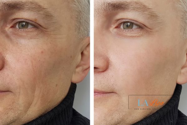 See the amazing results of Morpheus8 Treatment Merton Park!