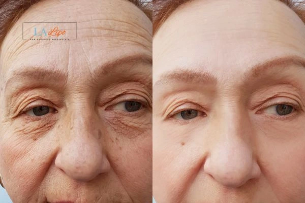 The powerful benefits of Morpheus8 Treatment Merton Park - Call Our team today!