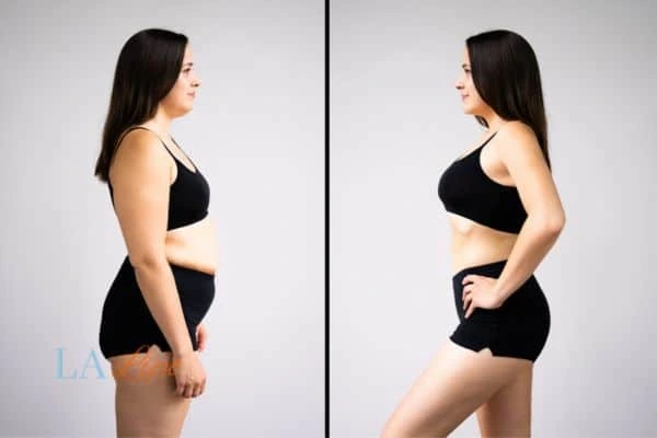 Picture of womans before and after using LA-EMS body sculpting to improve her core strength Merton Park