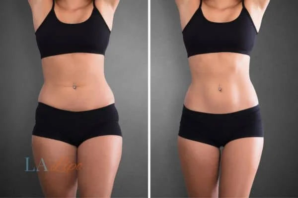 before and after results of non-surgical treatment to help a woman's body image and mental health Merton Park