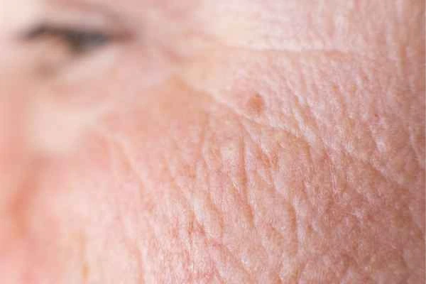 close up picture of a woman's face showing an age spot Merton Park