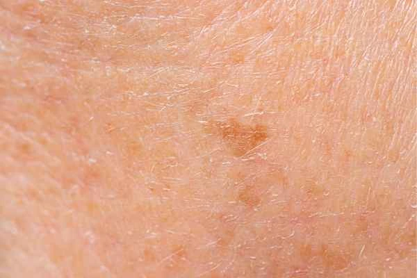 close up picture of age spots Merton Park