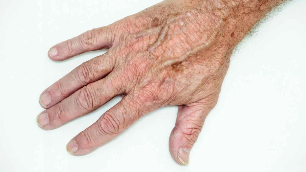 Male hand showing age spot Merton Park