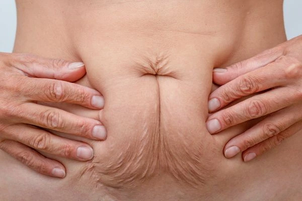 Should I Combine Diastasis Recti Treatment with Body Contouring for Better Results Merton Park?