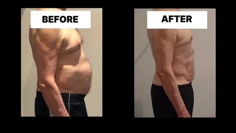 What Symptoms Can Diastasis Recti Cause in Men? Weak Core, Back Pain and Poor Posture Merton Park
